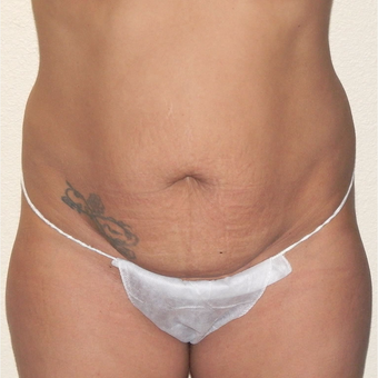 35 yr old woman treated with Tummy Tuck and Liposuction for contouring. before 3174312