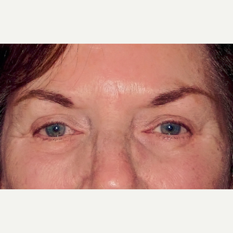 Eyelid Surgery (Blepharoplasty) after 3831618