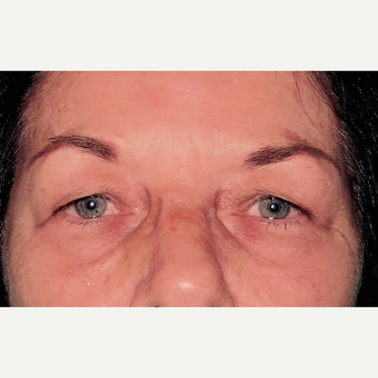 Eyelid Surgery (Blepharoplasty) before 3831618