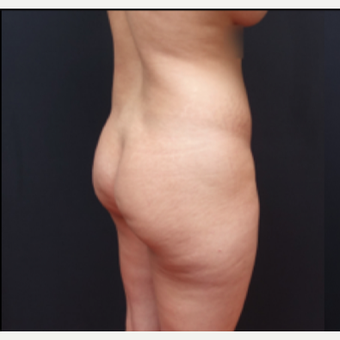 25-34 year old woman treated with Brazilian Butt Lift before 3266944