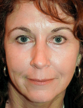45-54 year old woman treated with Eye Bags and Drooping Eyebrow Treatment after 1926097