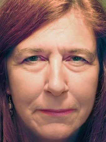 45-54 year old woman treated with Eye Bags and Drooping Eyebrow Treatment before 1926097