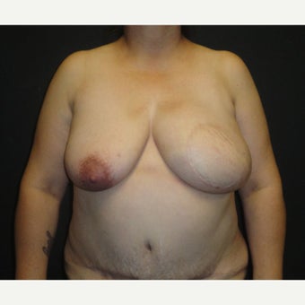 45-54 year old woman treated with Breast Reconstruction after 1895735