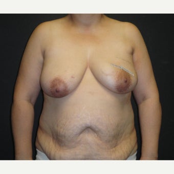 45-54 year old woman treated with Breast Reconstruction before 1895735