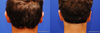 Ear Surgery before 1445765