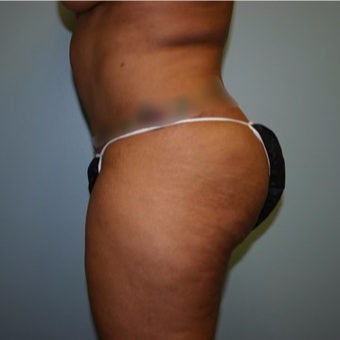 Brazilian Butt Lift before 3667404