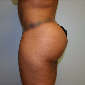 Brazilian Butt Lift after 3667404