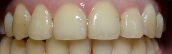Damon Braces after 3135156