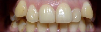 Damon Braces before 3135156