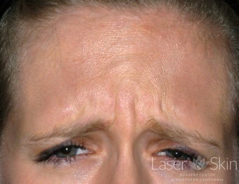 23 Year Old Female Preventative Treatment to Frown Lines before 1299464