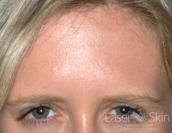 23 Year Old Female Preventative Treatment to Frown Lines after 1299464