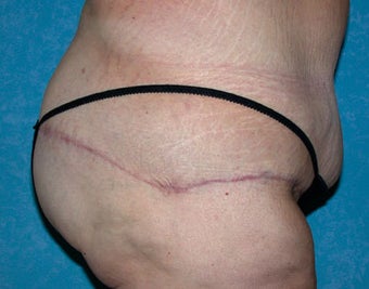 Buttock Augmentation with Circumferential Body Lift after 856873