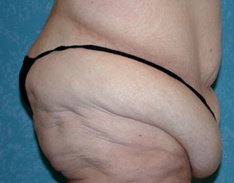 Buttock Augmentation with Circumferential Body Lift before 856873
