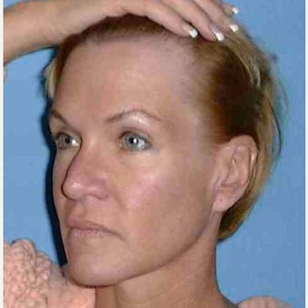 45 year old woman treated with Cheek Lift before 1725434