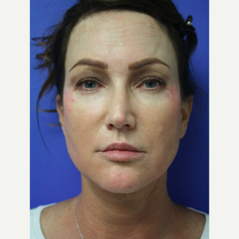 45-54 year old woman treated with Facelift Revision after 3405406