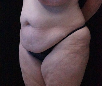 Tummy Tuck and Breast Reduction before 3332913