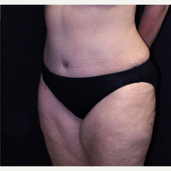 Tummy Tuck and Breast Reduction after 3332913