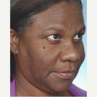 55-64 year old woman treated with Age Spots Treatment with Obagi Nu Derm Skin Transformation System before 2581732