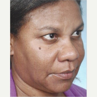 55-64 year old woman treated with Age Spots Treatment with Obagi Nu Derm Skin Transformation System after 2581732