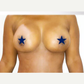 35-44 year old woman treated with Breast Lift with Implants after 3300473