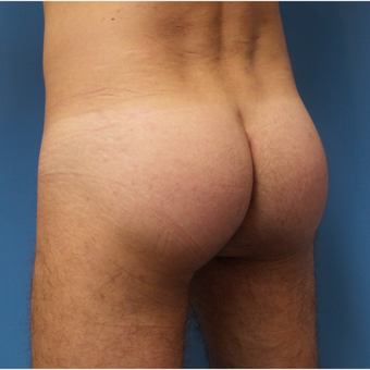 35-44 year old man treated with Butt Augmentation after 3341273