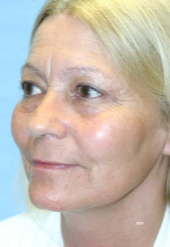 45-54 year old woman treated with Brow Lift before 1670193