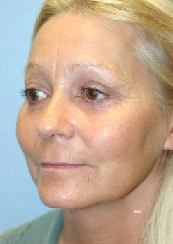 45-54 year old woman treated with Brow Lift after 1670193