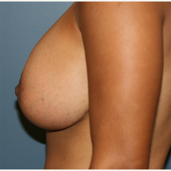 32 year old female Breast implants with lift after 3638906