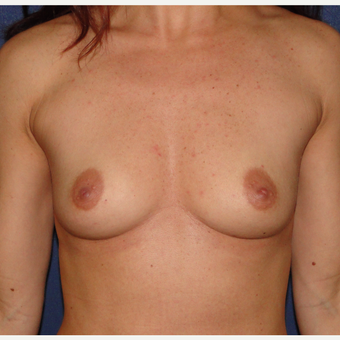 35-44 year old woman treated with Breast Augmentation before 3240016