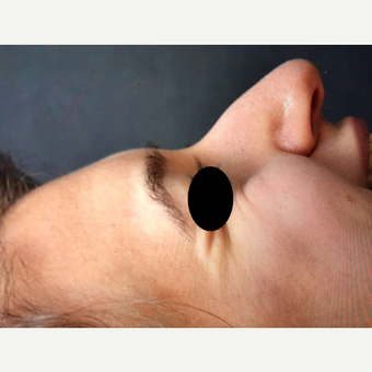 18-24 year old woman treated with Rhinoplasty before 3211769