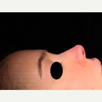 18-24 year old woman treated with Rhinoplasty after 3211769