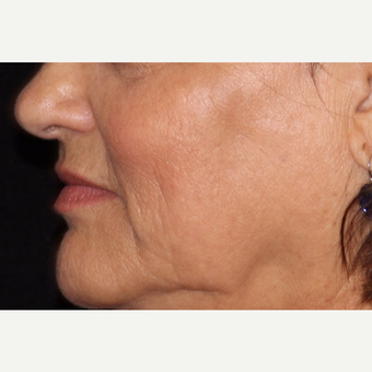 55-64 year old woman treated with IPL after 3501894