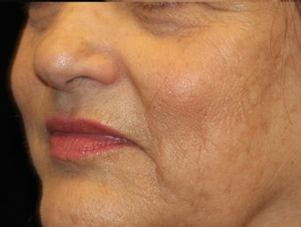 55-64 year old woman treated with IPL 3501894