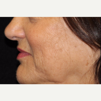 55-64 year old woman treated with IPL before 3501894