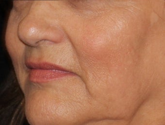 55-64 year old woman treated with IPL 3501894