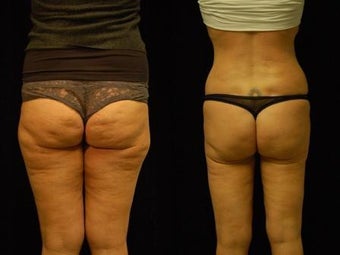 Cellulaze and Smartlipo Eleven Month Follow Up before 923104
