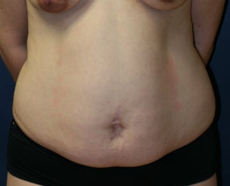Tummy Tuck (Abdominoplasty) before 1025631