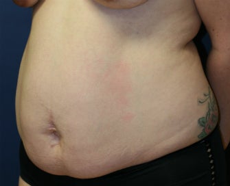 Tummy Tuck (Abdominoplasty) 1025631