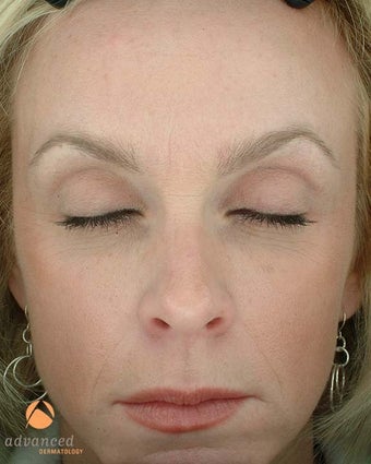 Female Patient Treated with BOTOX® Cosmetic after 1047038