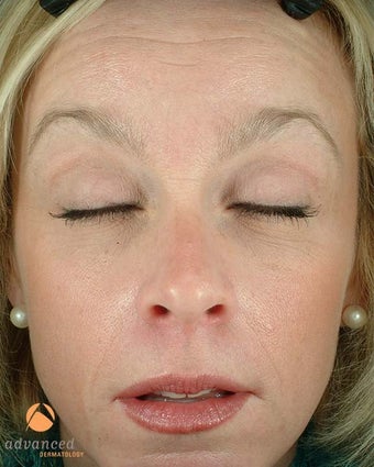Female Patient Treated with BOTOX® Cosmetic before 1047038