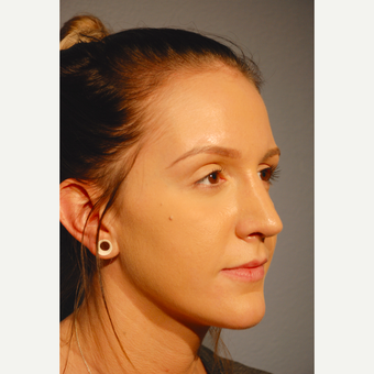 18-24 year old woman treated with Rhinoplasty after 3417496