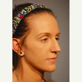 18-24 year old woman treated with Rhinoplasty before 3417496
