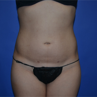 18-24 year old woman treated with Liposuction after 3611077
