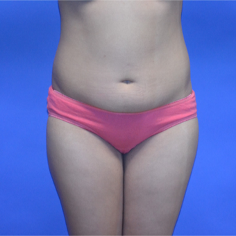 18-24 year old woman treated with Liposuction before 3611077