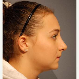 17 or under year old woman treated with Rhinoplasty after 3277637