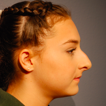 17 or under year old woman treated with Rhinoplasty before 3277637