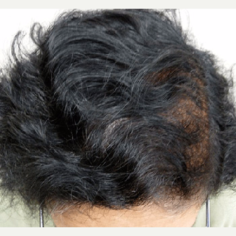 50 year old woman treated with Hair Transplant after 3608881