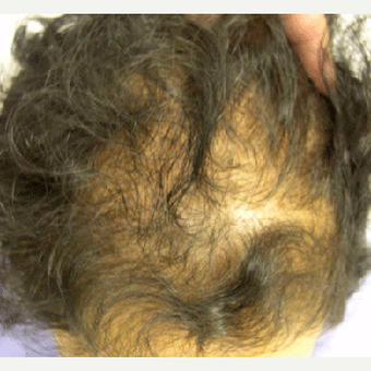 50 year old woman treated with Hair Transplant before 3608881