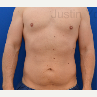 35-44 year old man treated with Tummy Tuck before 2746050
