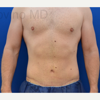 35-44 year old man treated with Tummy Tuck after 2746050